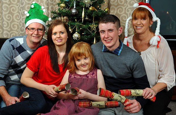 Mắc hội chứng Apert như bé Bôm, bé gái may mắn được tái sinh với khuôn mặt mới