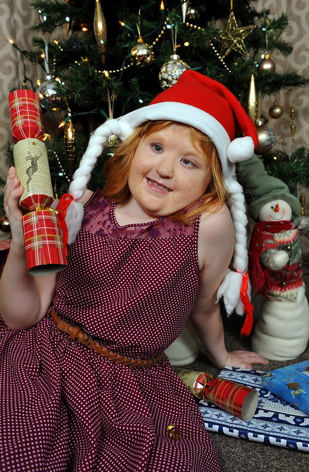 Mắc hội chứng Apert như bé Bôm, bé gái may mắn được tái sinh với khuôn mặt mới