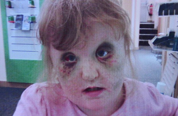 Mắc hội chứng Apert như bé Bôm, bé gái may mắn được tái sinh với khuôn mặt mới