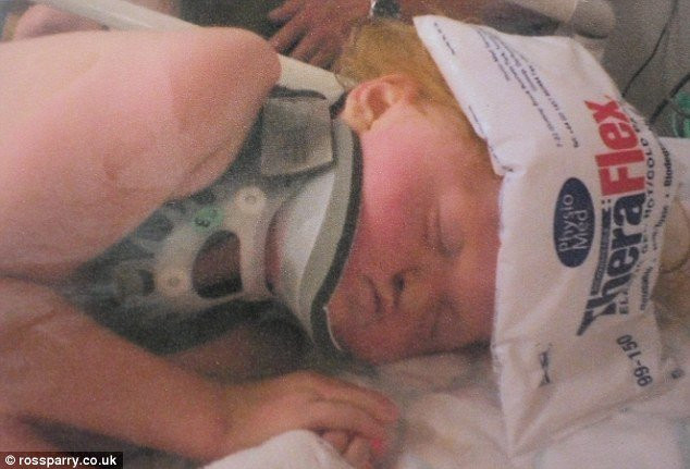 Mắc hội chứng Apert như bé Bôm, bé gái may mắn được tái sinh với khuôn mặt mới