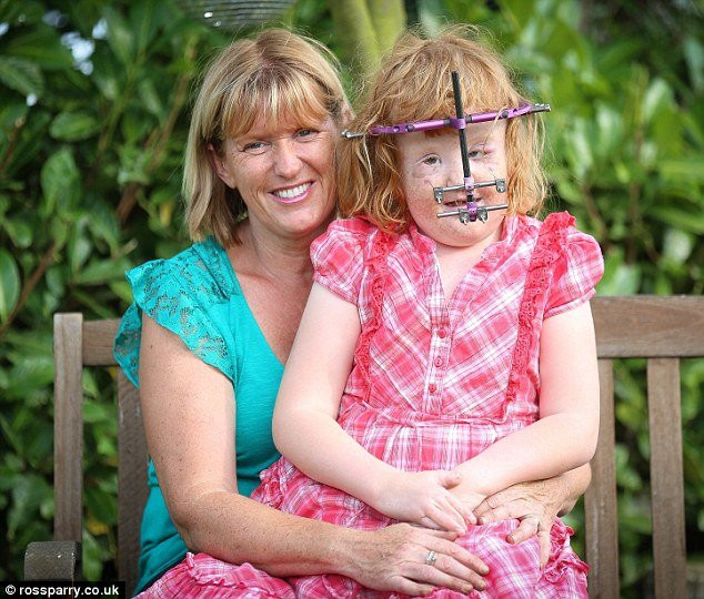 Mắc hội chứng Apert như bé Bôm, bé gái may mắn được tái sinh với khuôn mặt mới