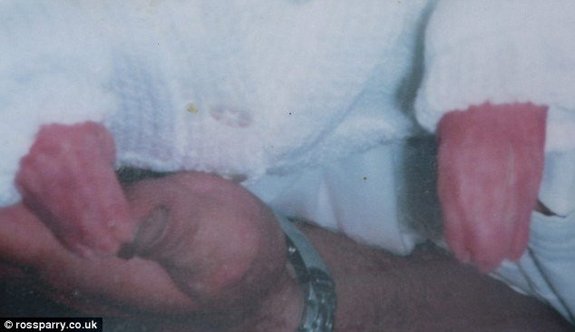 Mắc hội chứng Apert như bé Bôm, bé gái may mắn được tái sinh với khuôn mặt mới