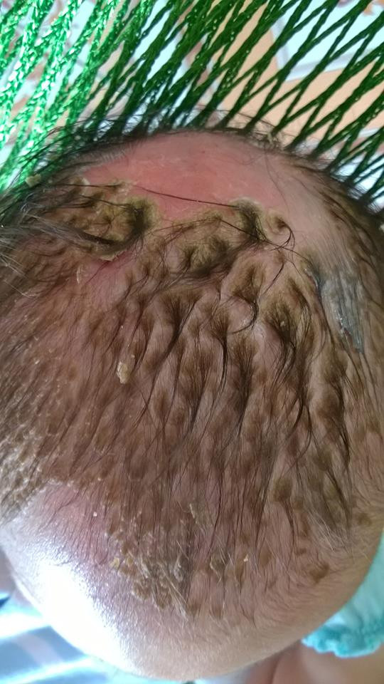 Xót xa mẹ gãi 'cứt trâu' cho con đến bong tróc cả mảng tóc, rộp đỏ da đầu