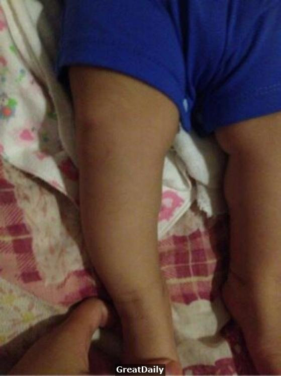 Mẹ mua giày lớn hơn 1 size để con đi được lâu, nào ngờ suýt hại con gãy xương chân