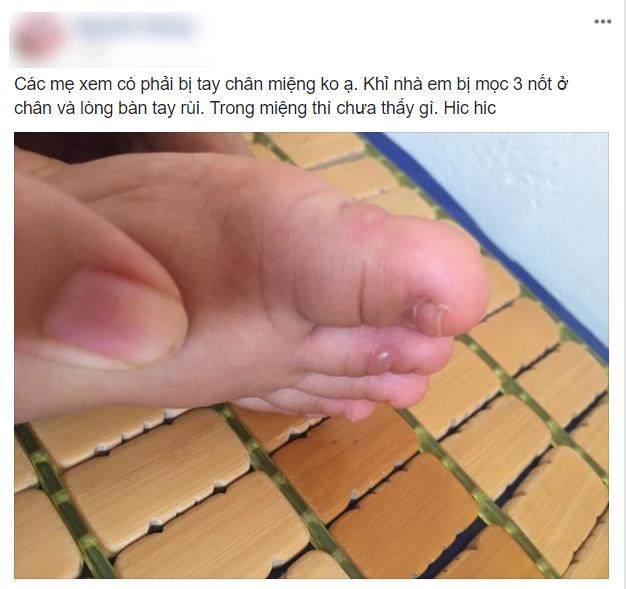 Những dấu hiệu cho thấy con bị tay chân miệng mẹ không thể xem thường