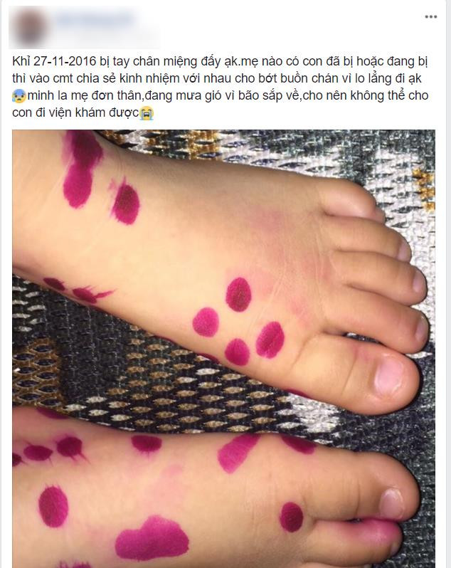 Những dấu hiệu cho thấy con bị tay chân miệng mẹ không thể xem thường