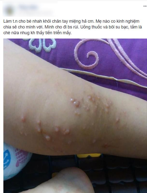 Những dấu hiệu cho thấy con bị tay chân miệng mẹ không thể xem thường