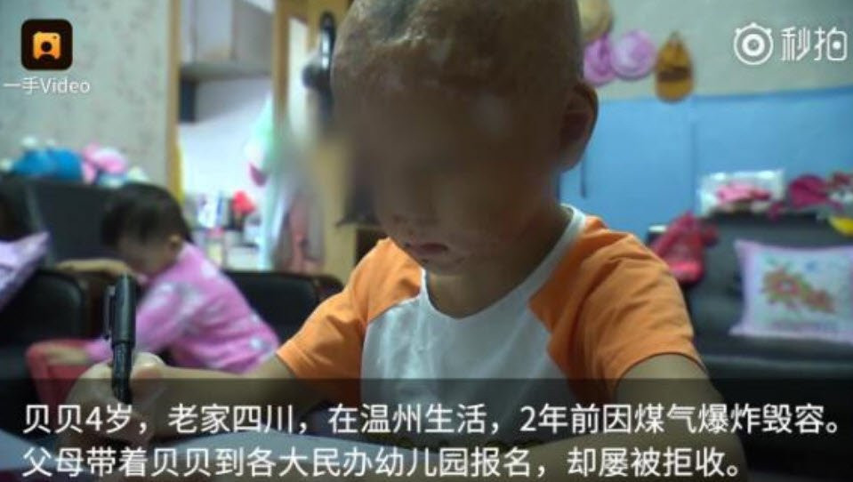 Ấm lòng cảnh hàng trăm học sinh xếp hàng chào đón cậu bé có gương mặt biến dạng vì bỏng