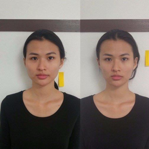 Thực hư phương pháp nắn xương thẩm mỹ để khuôn mặt thon gọn hơn đang được các sao ưa chuộng