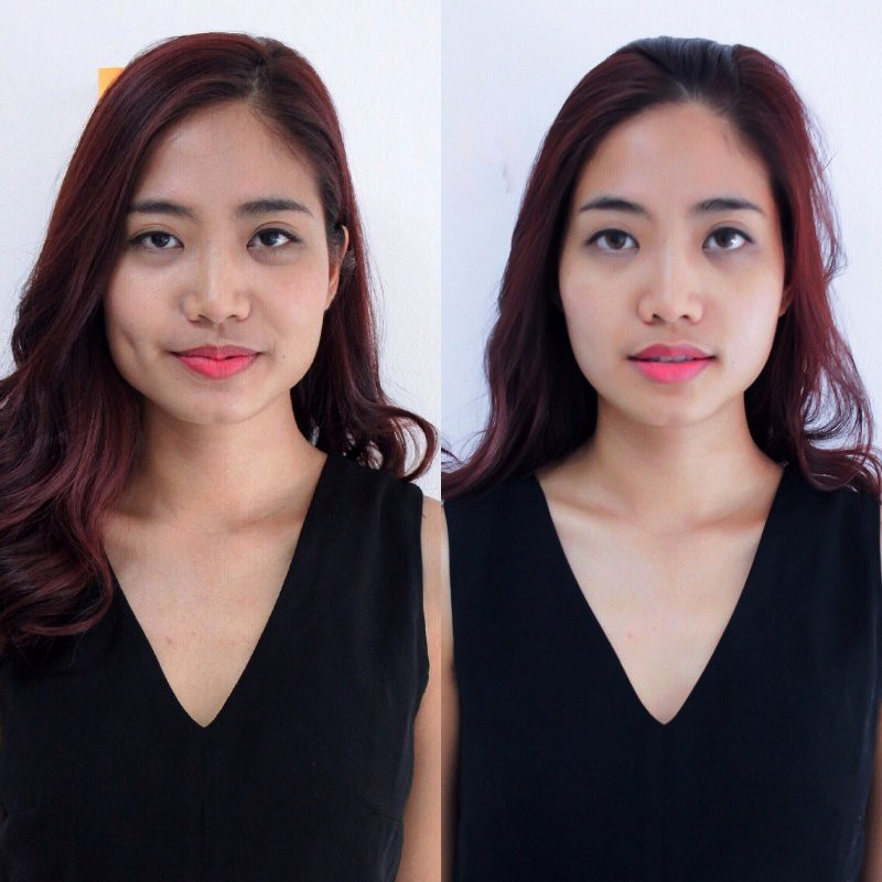 Thực hư phương pháp nắn xương thẩm mỹ để khuôn mặt thon gọn hơn đang được các sao ưa chuộng