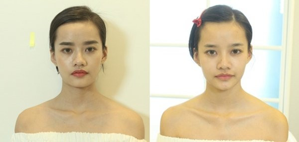 Thực hư phương pháp nắn xương thẩm mỹ để khuôn mặt thon gọn hơn đang được các sao ưa chuộng
