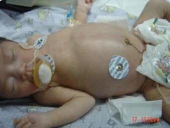 Bé sơ sinh 13 ngày tuổi bị hoại tử ruột vì mẹ pha sữa sai cách