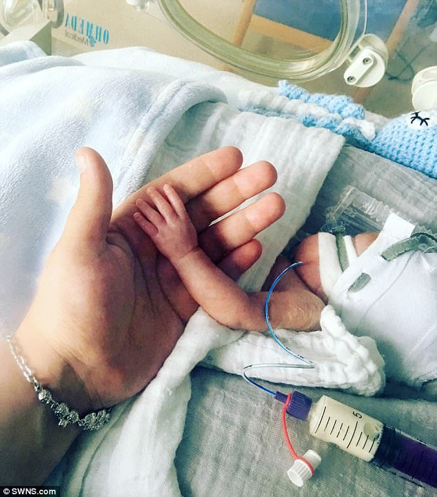 Kỳ diệu em bé sống sót khi sinh non ở tuần 22, làn da trong suốt nhìn thấy cả nội tạng