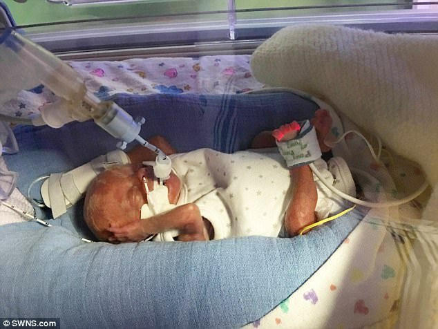 Kỳ diệu em bé sống sót khi sinh non ở tuần 22, làn da trong suốt nhìn thấy cả nội tạng