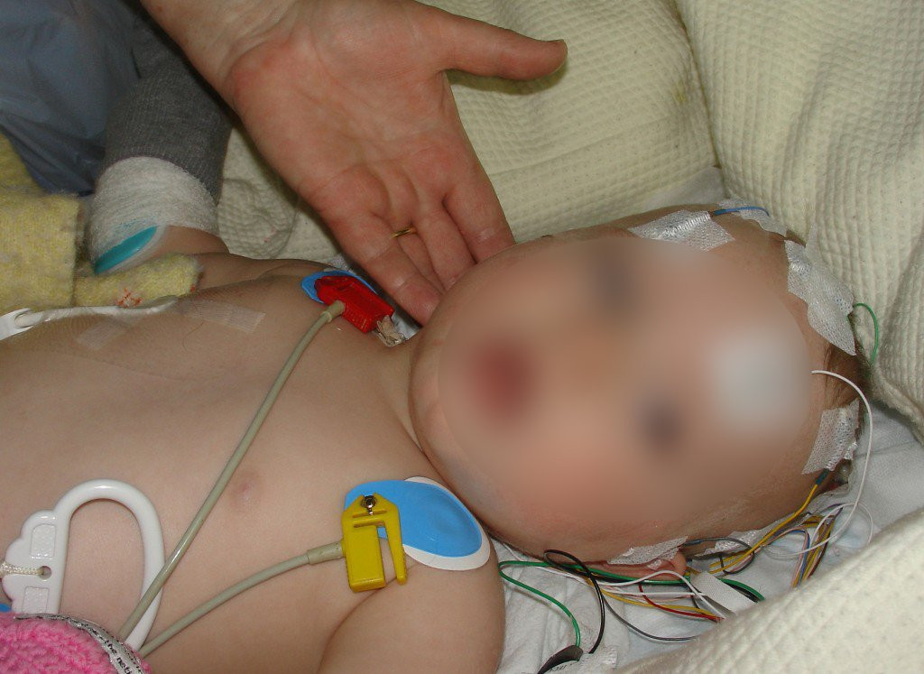 Bé sơ sinh xuất huyết não do thiếu vitamin K và lời cảnh tỉnh tới các mẹ