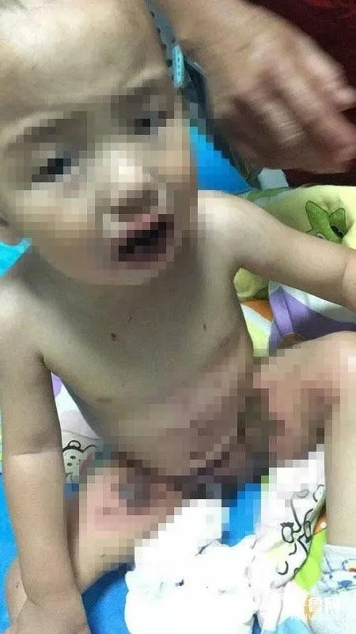 Ăn nhầm thuốc tẩy, bé trai 1 tuổi bị bỏng nặng khắp người