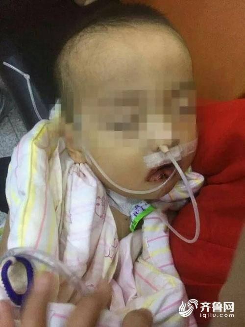 Ăn nhầm thuốc tẩy, bé trai 1 tuổi bị bỏng nặng khắp người