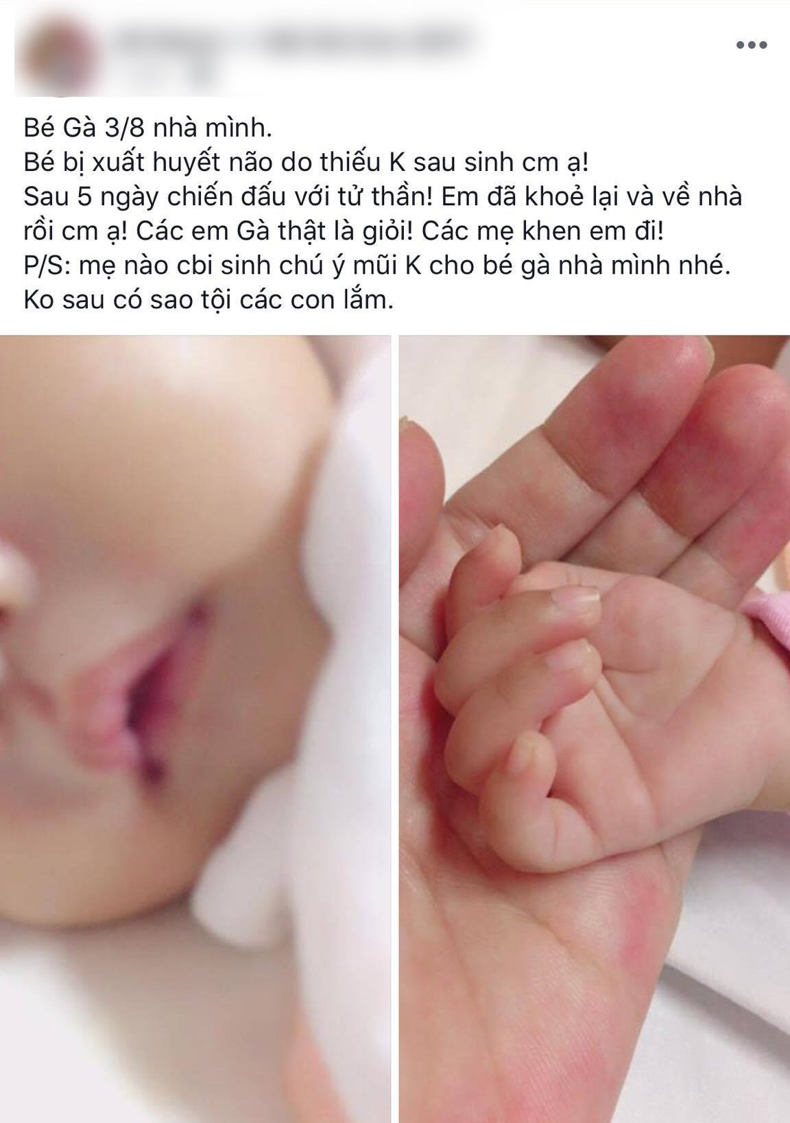 Bé sơ sinh xuất huyết não do thiếu vitamin K và lời cảnh tỉnh tới các mẹ