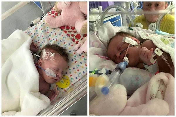 Bé gái sống sót kỳ diệu dù nứt bụng bẩm sinh, ruột nằm... ngoài bụng