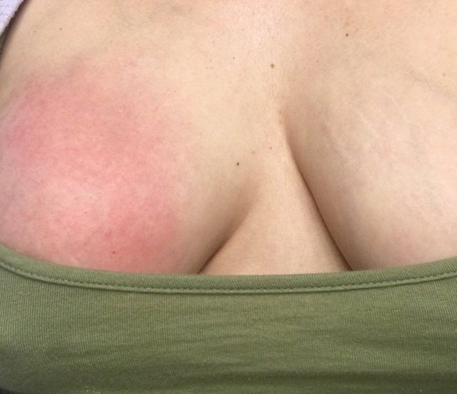 Xót xa nhìn bầu ngực sưng tím chứa đầy dịch của người mẹ khi cho con bú