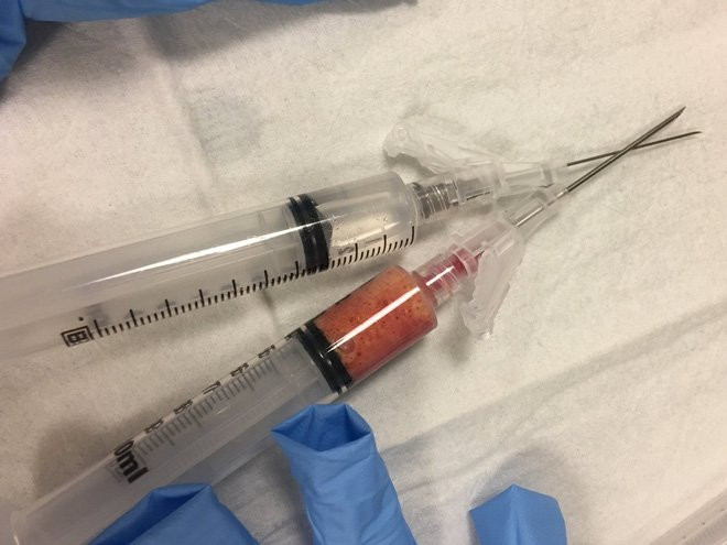 Xót xa nhìn bầu ngực sưng tím chứa đầy dịch của người mẹ khi cho con bú