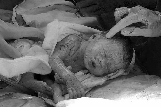 Kỳ diệu ca sinh 3 nhờ thụ tinh ống nghiệm, 1 bé còn nằm nguyên trong bọc ối