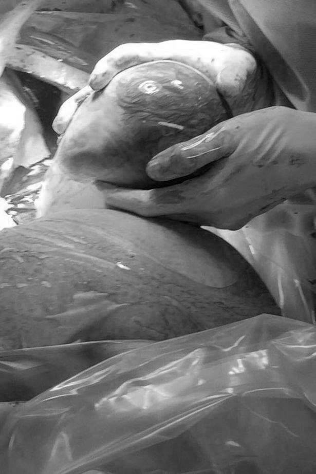 Kỳ diệu ca sinh 3 nhờ thụ tinh ống nghiệm, 1 bé còn nằm nguyên trong bọc ối