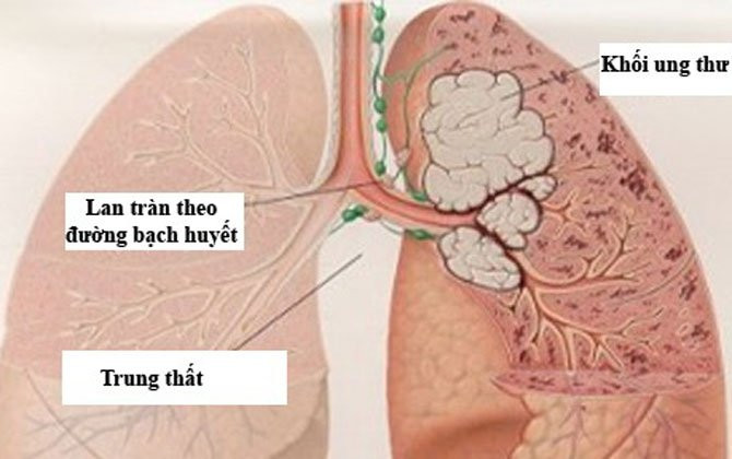 Cậu bé 2 tuổi bị mắc ung thư phổi vì lý do chẳng thể ngờ