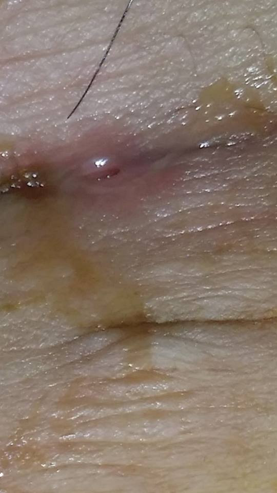 Mẹ bỉm sữa chảy mủ, sưng tấy vết mổ vì dị ứng chỉ tự tiêu sau sinh