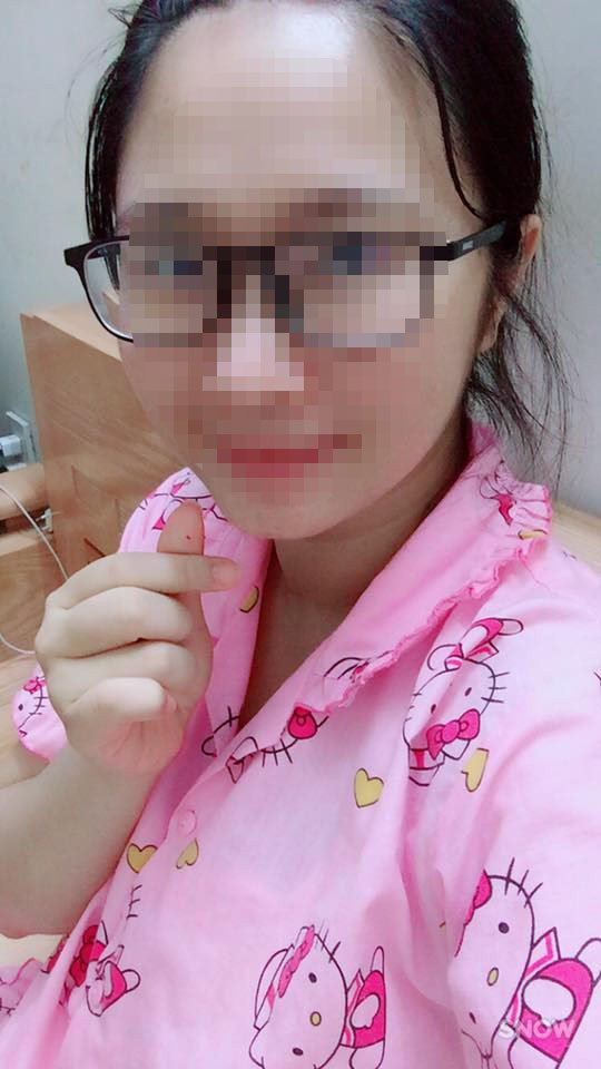 Mẹ bỉm sữa chảy mủ, sưng tấy vết mổ vì dị ứng chỉ tự tiêu sau sinh