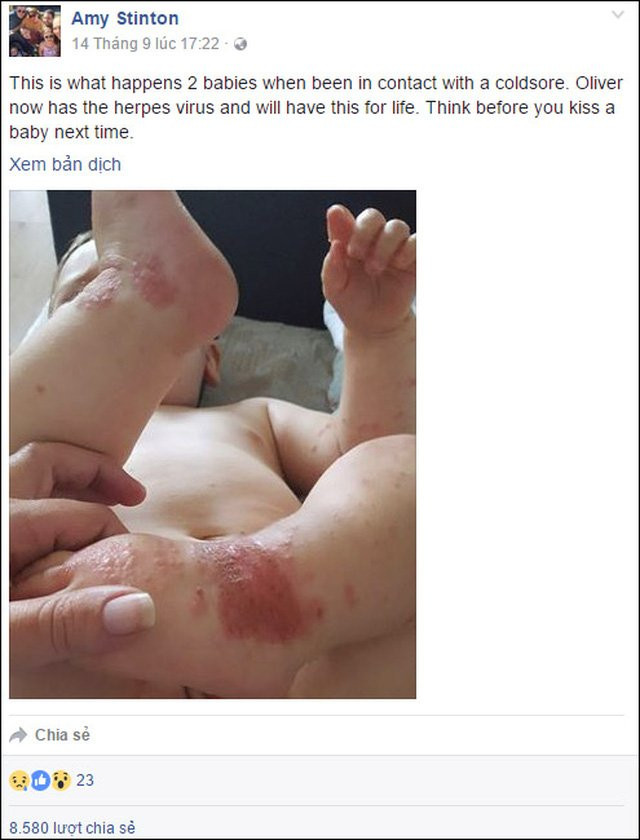 Được người nhà ôm hôn, em bé nhiễm virus viêm phổi