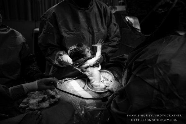 Xúc động người mẹ phải cắt một bên ngực vì ung thư vú vẫn cố cho con bú