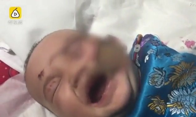 Ngã vào bếp lò dùng để sưởi ấm, bé gái bỏng cấp độ 3