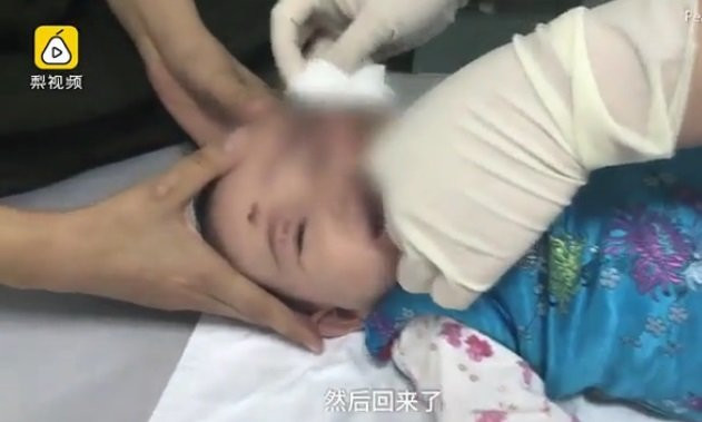 Ngã vào bếp lò dùng để sưởi ấm, bé gái bỏng cấp độ 3