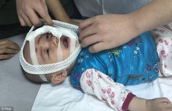 Ngã vào bếp lò dùng để sưởi ấm, bé gái bỏng cấp độ 3