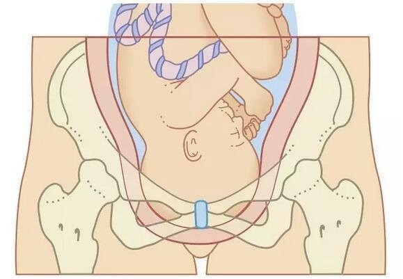 Mẹ có đặc điểm này, dù muốn sinh thường đến đâu vẫn phải ngậm ngùi sinh mổ