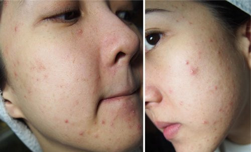 Image result for mặt mụn