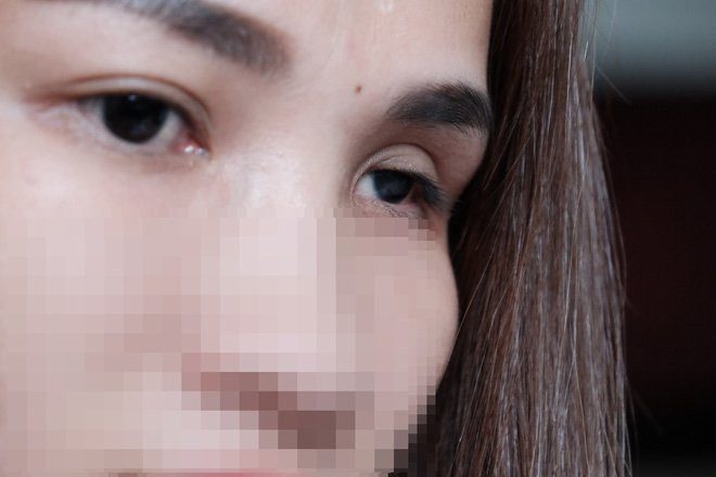 Cô gái mù mắt trái sau khi tiêm filler: “Không có bạn trai, tôi đã không gắng gượng được đến lúc này” - Ảnh 1. Cô gái mù mắt trái sau khi tiêm filler: “Không có bạn trai, tôi đã không gắng gượng được đến lúc này” - Ảnh 1.