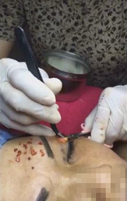 Cô gái mù mắt trái sau khi tiêm filler: “Không có bạn trai, tôi đã không gắng gượng được đến lúc này” - Ảnh 4. Cô gái mù mắt trái sau khi tiêm filler: “Không có bạn trai, tôi đã không gắng gượng được đến lúc này” - Ảnh 4.