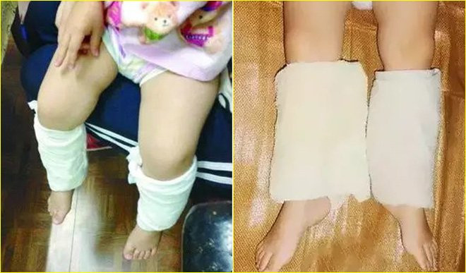 Buộc khăn bắp chân - Phương pháp hạ sốt cho con của mẹ Đức, các mẹ đã biết chưa? - Ảnh 3.