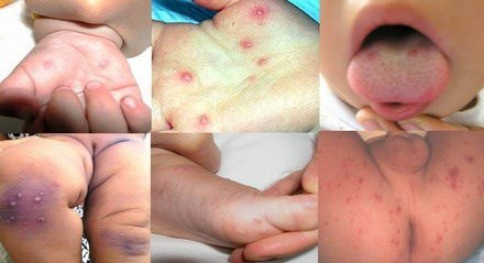 cach_ngan_ngua_va_cham_soc_tre_bi_tay_chan_mieng-giaoduc.net.vn