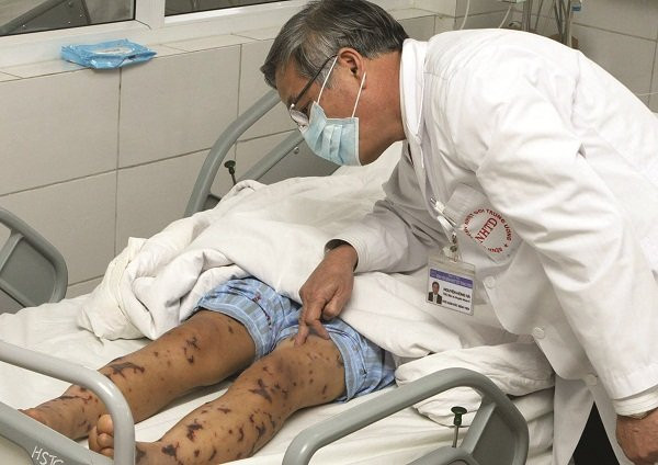 ngan_ngua_benh_nao_mo_cau_1