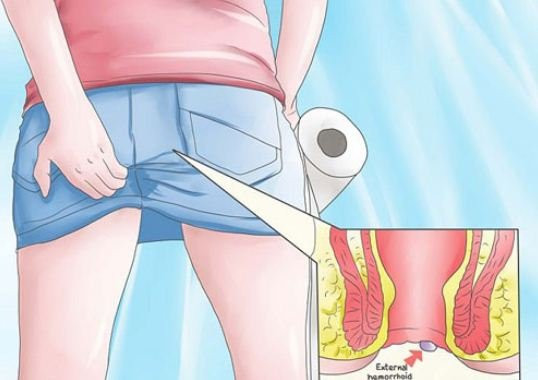 Hau-mon-noi-cuc-nho-va-dau-dau-hieu-benh-tri