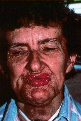 lesch-nyhan_syndrome-2022