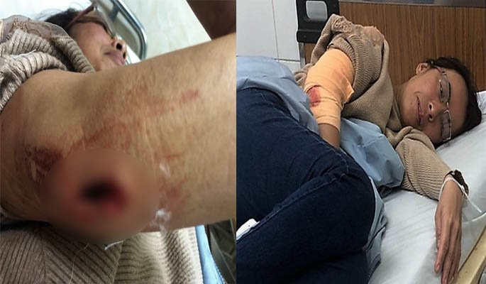 nhom-bit-mat-chem-trong-thuong-mot-phu-nu