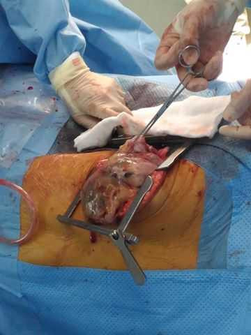 khi-u-quai-trong-lng-ngc-nam-bnh-nhan-18-tui