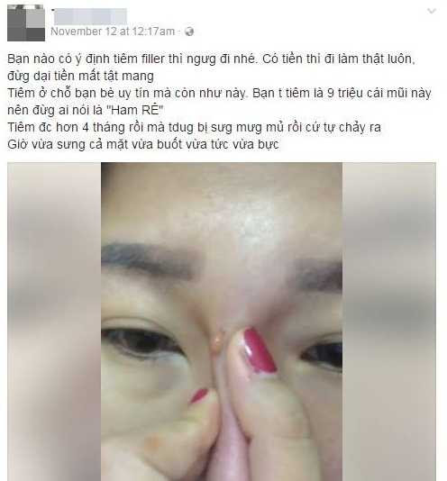 hotgirl-bi-chay-dich-mu-sau-tiem-filler-nang-mui-hinh-2