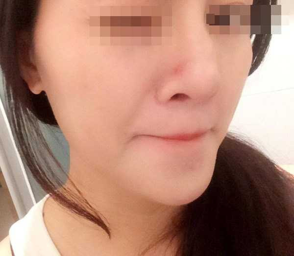 hotgirl-bi-chay-dich-mu-sau-tiem-filler-nang-mui-hinh-3