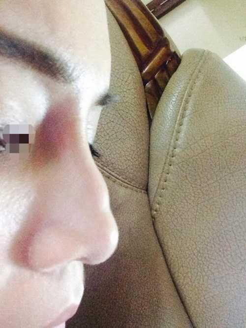 hotgirl-bi-chay-dich-mu-sau-tiem-filler-nang-mui-hinh-4