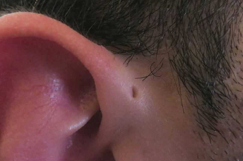Preauricular-sinus-Ear-hole